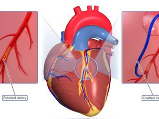 cardiovascular-surgery cardiovascular-surgery